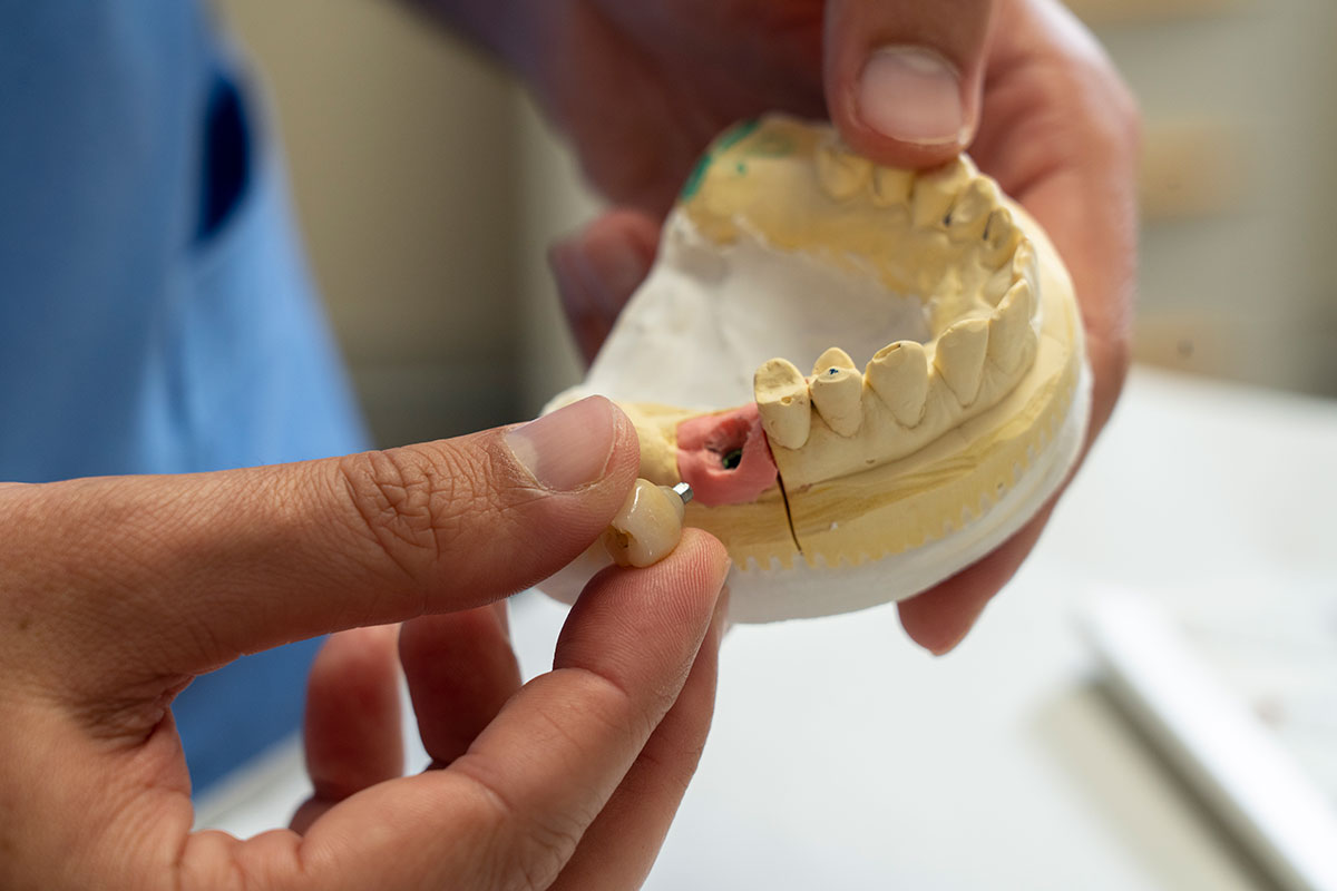 Implantologia dentale implantologia dentale