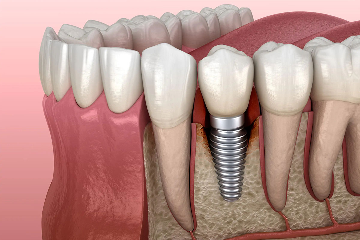 implantologia dentale